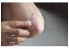 Psoriasis Market Size & Share Reports