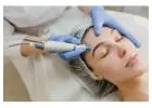 Revitalize Your Skin with Microneedling in Richmond Hill