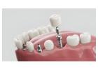 Siiodent Implants: Precision & Quality in Dental Implant Manufacturing