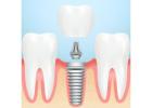 Siiodent Implants: One of the Best Dental Implant Brands