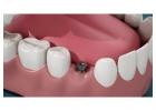 Siiodent Implants – Leading Dental Implant Manufacturer for Superior Solutions