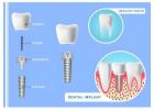 Siiodent Implants: Quality Prosthetic Accessories in USA