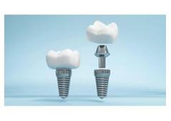 Siiodent Implants: Why Choose Hex Implants?