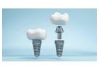 Siiodent Implants: Why Choose Hex Implants?