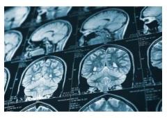 Fighting for Brain Injury Victims in Rancho Cucamonga Legal Help Available