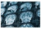Fighting for Brain Injury Victims in Rancho Cucamonga Legal Help Available