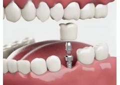 HSI Conical Implants Designed for Success | Siiodent Implants