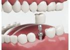 HSI Conical Implants Designed for Success | Siiodent Implants