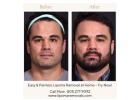 Easy & Painless Lipoma Removal at Home – Try Now!