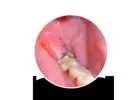 Expert Wisdom Teeth Surgeons Available Today
