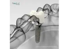 Best Dental Implant Equipment in Peru | Quality Tools