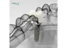 Best Dental Implant Equipment in Peru | Quality Tools
