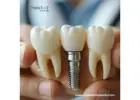 Best Dental Implant Wholesalers in Paraguay Listed