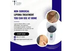 Non-Surgical Lipoma Treatment You Can Use at Home