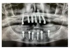 All-on-4 Dental Implants in Tijuana, Mexico – Affordable, Life-Changing Results!