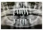 All-on-4 Dental Implants in Tijuana, Mexico – Affordable, Life-Changing Results!