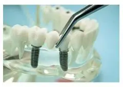 Top siiodentimplants dental implant technology for professionals