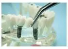 Top siiodentimplants dental implant technology for professionals