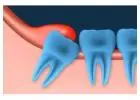 Infected Wisdom Teeth