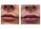 Professional Fillers service in Wollongong