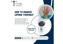 How to Remove a Lipoma Yourself Naturally?