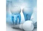 Top-Quality Dental Implant OEM Suppliers in Guatemala