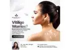 Vitiligo Specialist Doctor in Patna – Personalized Care at Kiran Skin Clinic