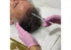 Best Hair Loss Treatment in Holland Park