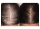 Hair Loss Treatment For Men