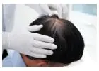 Hair loss for men