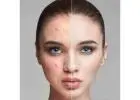 Pimple Scar Treatment