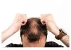 Hair Loss Treatment for men