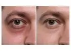 Dark Circle Under Eye Treatment