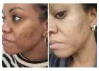 Laser removal of skin tag
