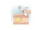 Remove Lipoma Yourself – Safe Home Solution!