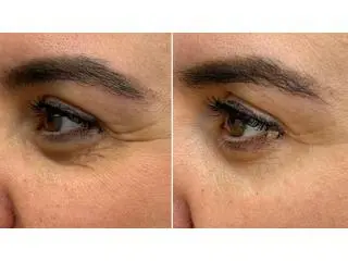 Rejuvenate Your Skin Naturally with Polynucleotides Treatment – See Visible Results! Rejuvenate Your Skin Naturally with Polynucleotides Treatment – See Visible Results!