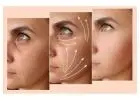 Rejuvenate Your Look with an 8 Point Liquid Facelift – No Surgery, Instant Lift!