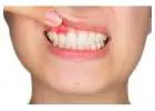 Teeth Whitening In Gurgaon