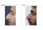 Nose surgery cost in Delhi - Dr Rajat Gupta