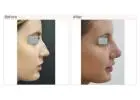 Rhinoplasty Surgery Before and After: Real Results and What to Expect