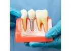 Dental Implant Solutions in Chembur,