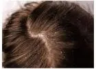 Homeopathic Integrative Care for Persistent Dandruff