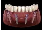 All-on-4 Dental Implants in Tijuana, Mexico – Affordable, Life-Changing Results!