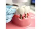 Dental Implant Therapy: A Long-Lasting Solution for Missing Teeth