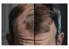Best Hair Loss Treatment to Restore Hair Health and Confidence
