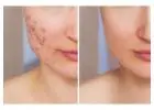 acne scar removal treatment