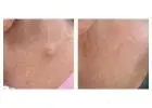 Same Day Cyst Removal – Fast and Safe Treatment in London