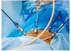 Laparoscopy for Infertility Cost in Delhi - Dr Rhythm Gupta