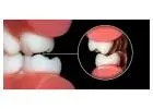 Root Canal Treatment In Jaipur