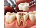 Affordable vs Premium Dental Implant Clinics in Delhi: What’s the Difference?